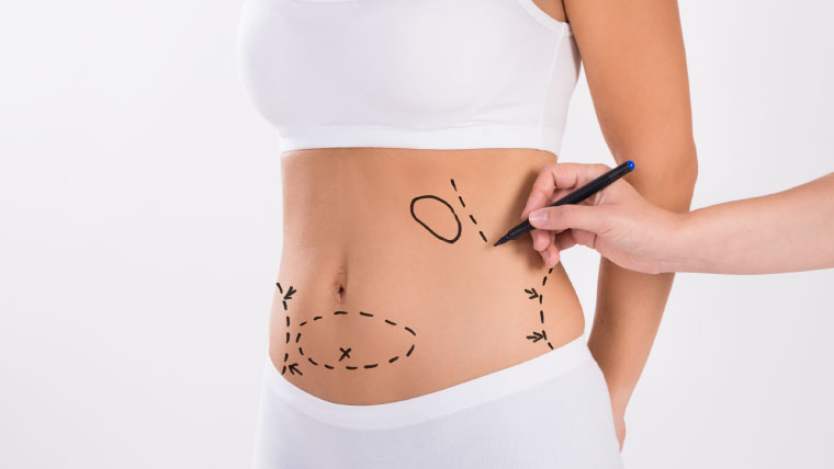 abdominoplastia-a-cirurgia-que-remodela-a-barriga