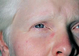 Face de uma mulher com albinismo. Esta doença genética caracteriza-se pela falta de melanina, o que resulta em pele muito pálida e cabelos, sobrancelhas e cílios brancos