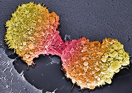 Imagem de células do cancro do pâncreas
