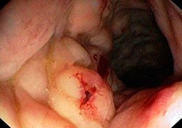 Enterocolite Necrosante