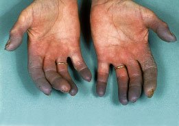doença raynaud