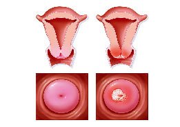 Cancro colo do útero