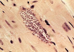 Doença de Chagas