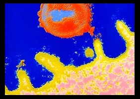 Difteria