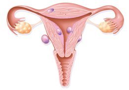 mioma uterino