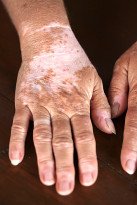 Vitiligo