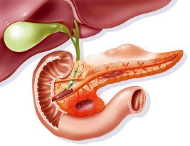 Pancreatite aguda