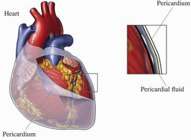 Pericardite
