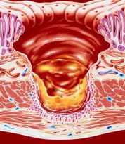 Úlcera Gastro-duodenal