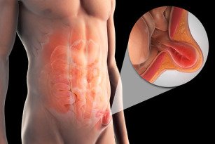 hernia inguinal