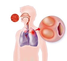 Tuberculose