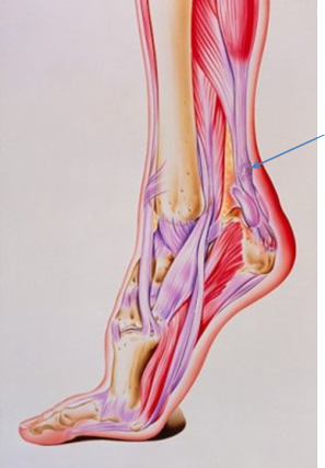 Tendinite de Aquiles, o inflamação do tendão de Aquiles junto ao calcanhar.