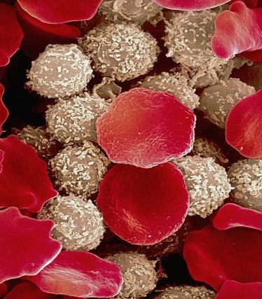 Células de um paciente com leucemia.