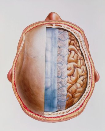 meningite