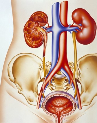 Sistema urinário que mostra a infeção de um rim (pielonefrite), com zonas purulentas visíveia a amarelo.